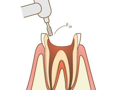 歯冠部分を削る図