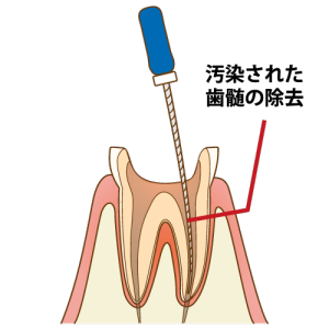 歯髄除去の図