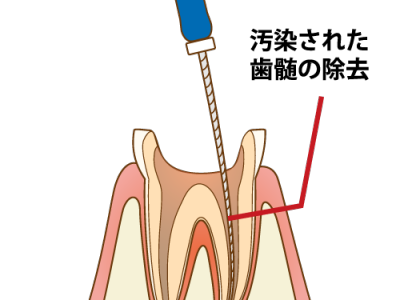 歯髄除去の図